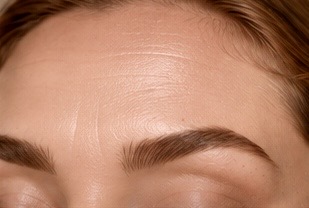 Botox kezelés
